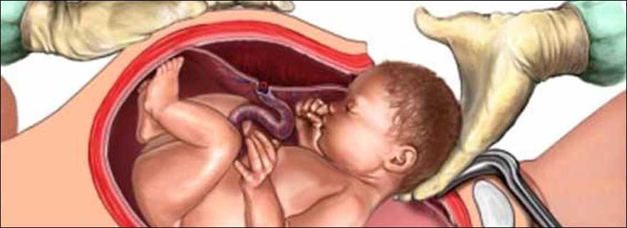 Cesarean Child Birth